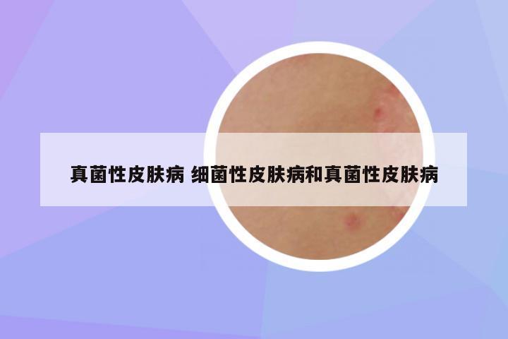真菌性皮肤病 细菌性皮肤病和真菌性皮肤病