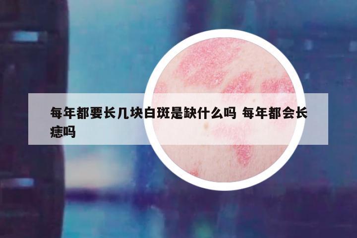 每年都要长几块白斑是缺什么吗 每年都会长痣吗