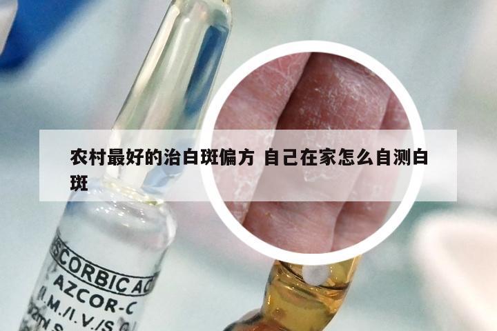 农村最好的治白斑偏方 自己在家怎么自测白斑