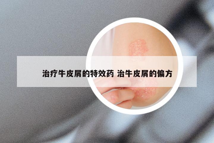 治疗牛皮屑的特效药 治牛皮屑的偏方