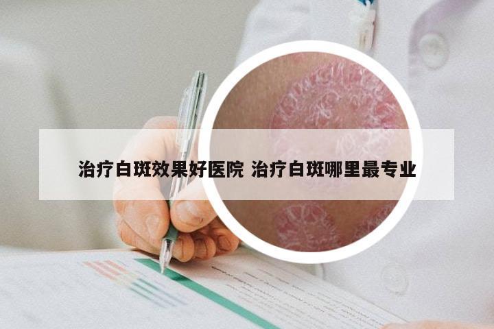 治疗白斑效果好医院 治疗白斑哪里最专业