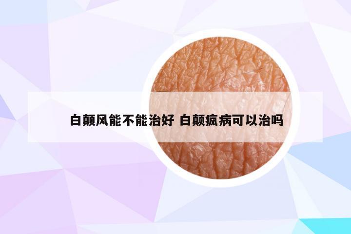 白颠风能不能治好 白颠疯病可以治吗