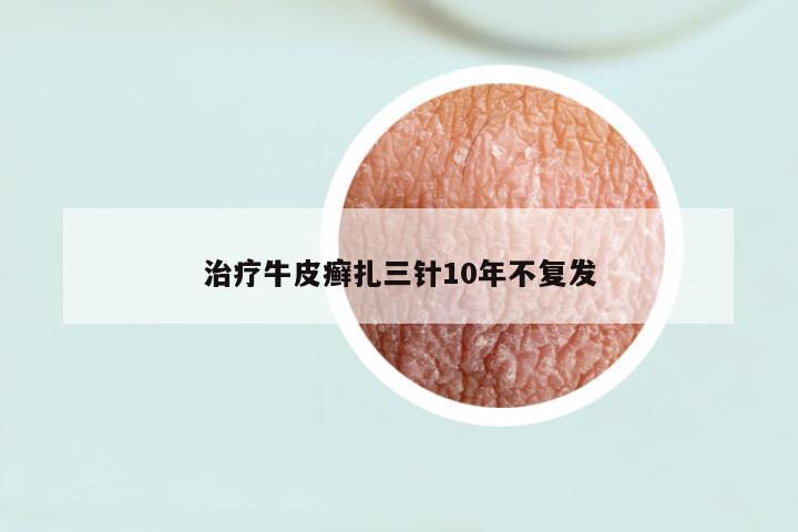 治疗牛皮癣扎三针10年不复发