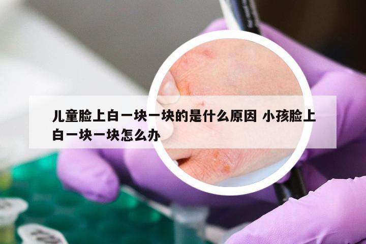 儿童脸上白一块一块的是什么原因 小孩脸上白一块一块怎么办