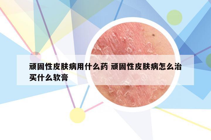 顽固性皮肤病用什么药 顽固性皮肤病怎么治买什么软膏