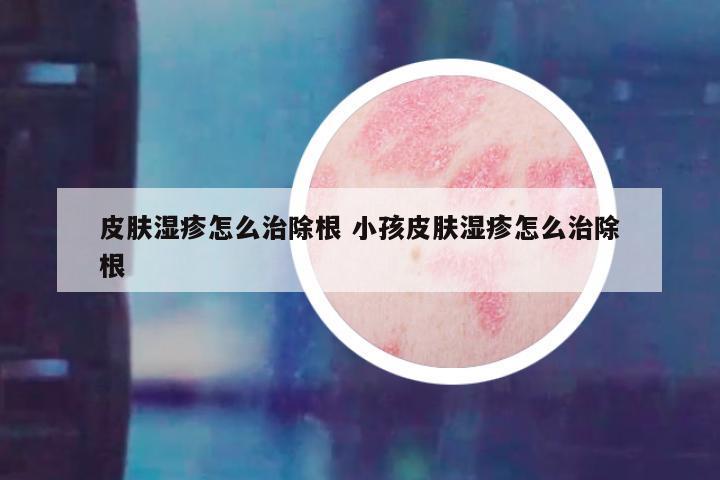 皮肤湿疹怎么治除根 小孩皮肤湿疹怎么治除根