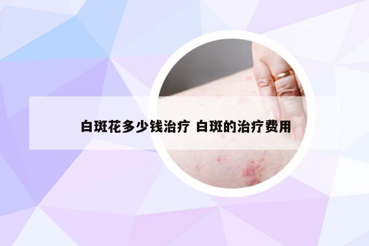 白斑花多少钱治疗 白斑的治疗费用