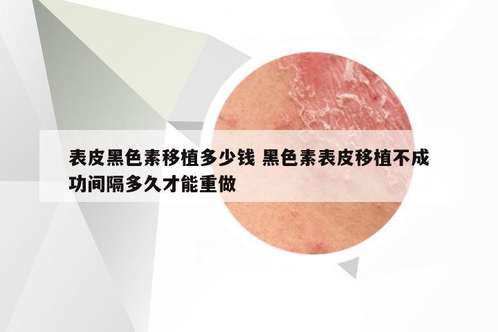 表皮黑色素移植多少钱 黑色素表皮移植不成功间隔多久才能重做