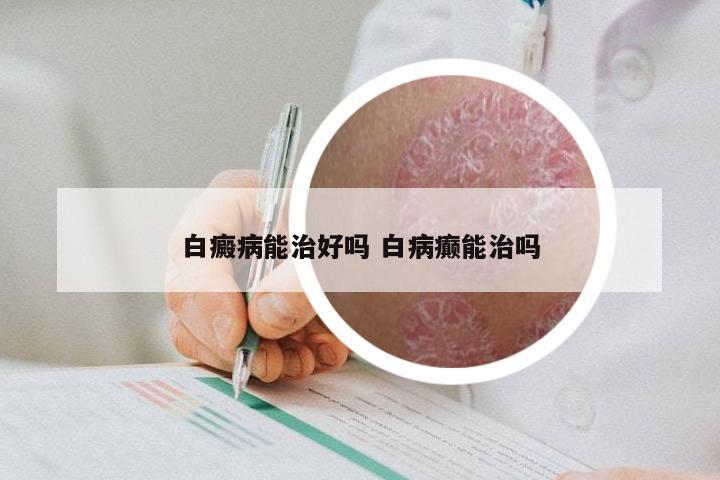白癜病能治好吗 白病癫能治吗