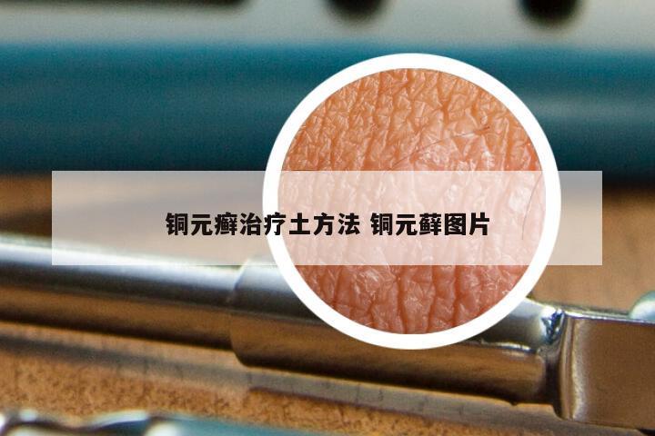 铜元癣治疗土方法 铜元藓图片