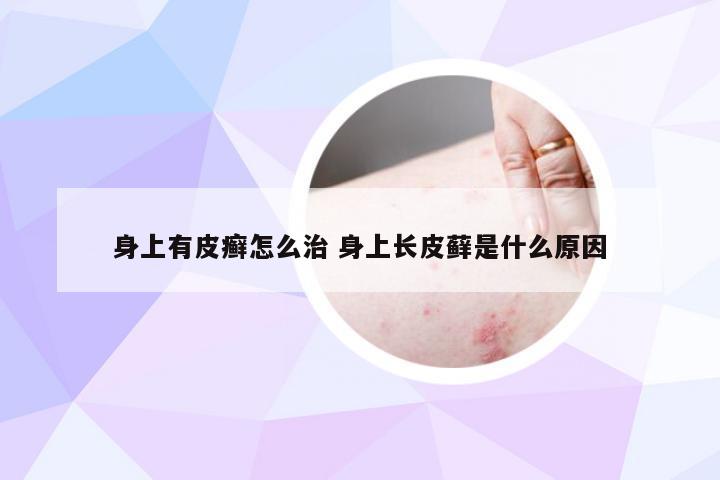 身上有皮癣怎么治 身上长皮藓是什么原因
