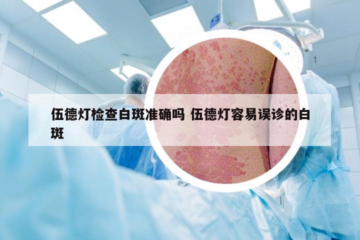 伍德灯检查白斑准确吗 伍德灯容易误诊的白斑