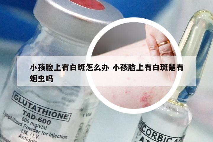 小孩脸上有白斑怎么办 小孩脸上有白斑是有蛔虫吗