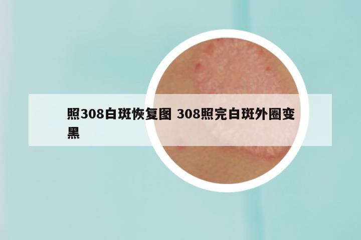 照308白斑恢复图 308照完白斑外圈变黑