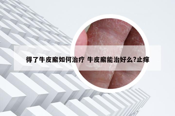 得了牛皮廨如何治疗 牛皮廨能治好么?止痒