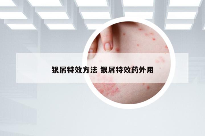 银屑特效方法 银屑特效药外用