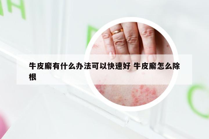 牛皮廨有什么办法可以快速好 牛皮廨怎么除根
