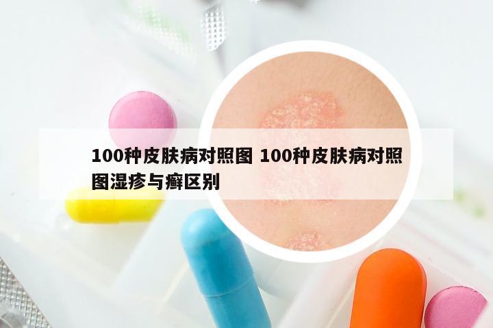 100种皮肤病对照图 100种皮肤病对照图湿疹与癣区别