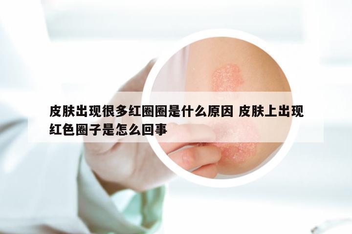 皮肤出现很多红圈圈是什么原因 皮肤上出现红色圈子是怎么回事