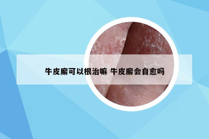 牛皮廨可以根治嘛 牛皮廨会自愈吗
