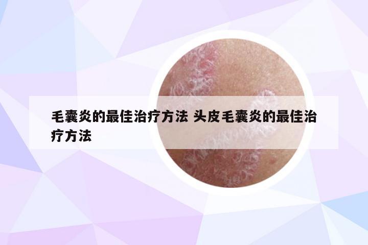 毛囊炎的最佳治疗方法 头皮毛囊炎的最佳治疗方法