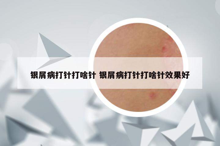 银屑病打针打啥针 银屑病打针打啥针效果好