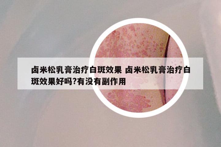 卤米松乳膏治疗白斑效果 卤米松乳膏治疗白斑效果好吗?有没有副作用