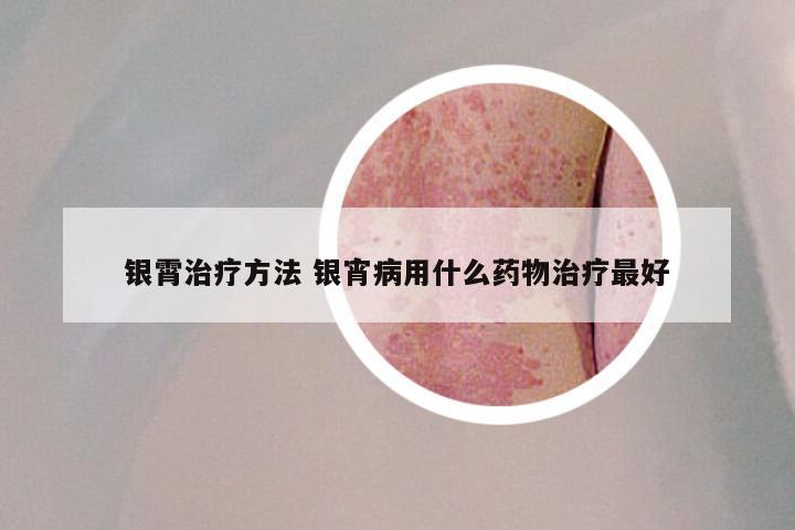 银霄治疗方法 银宵病用什么药物治疗最好