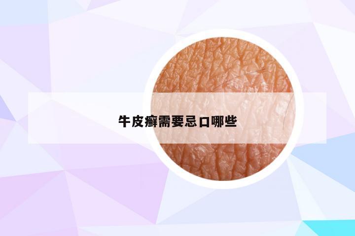 牛皮癣需要忌口哪些