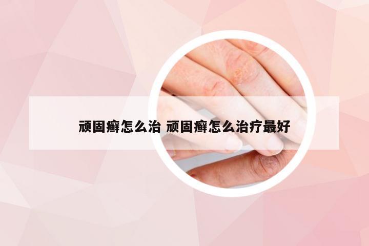 顽固癣怎么治 顽固癣怎么治疗最好