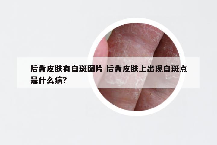 后背皮肤有白斑图片 后背皮肤上出现白斑点是什么病?