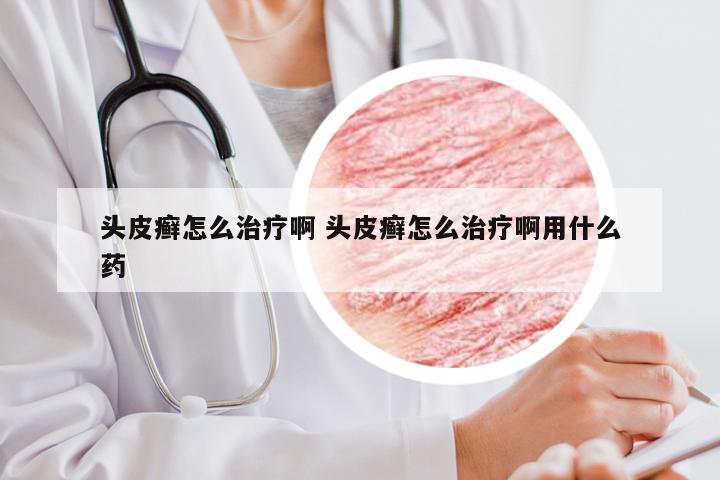 头皮癣怎么治疗啊 头皮癣怎么治疗啊用什么药