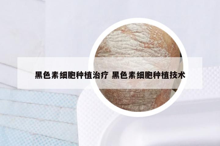 黑色素细胞种植治疗 黑色素细胞种植技术