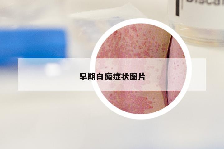早期白癜症状图片