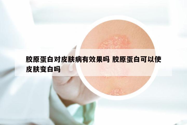 胶原蛋白对皮肤病有效果吗 胶原蛋白可以使皮肤变白吗