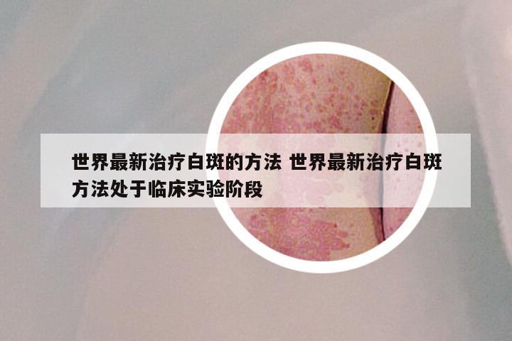 世界最新治疗白斑的方法 世界最新治疗白斑方法处于临床实验阶段