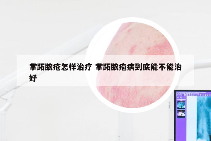 掌跖脓疮怎样治疗 掌跖脓疱病到底能不能治好