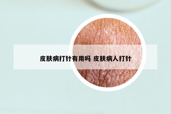 皮肤病打针有用吗 皮肤病人打针