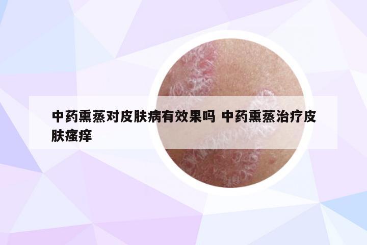 中药熏蒸对皮肤病有效果吗 中药熏蒸治疗皮肤瘙痒