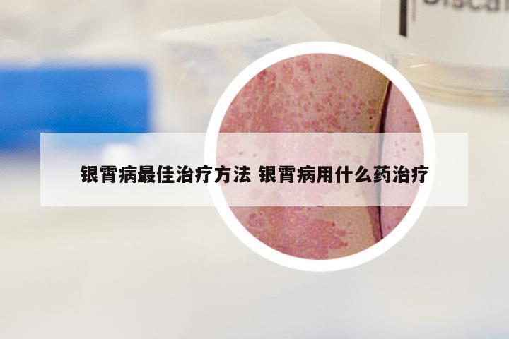 银霄病最佳治疗方法 银霄病用什么药治疗
