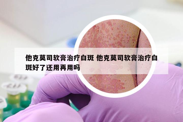 他克莫司软膏治疗白斑 他克莫司软膏治疗白斑好了还用再用吗
