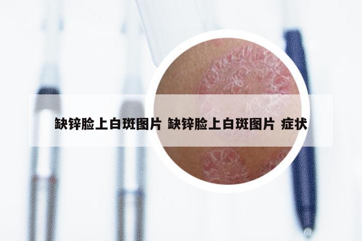 缺锌脸上白斑图片 缺锌脸上白斑图片 症状