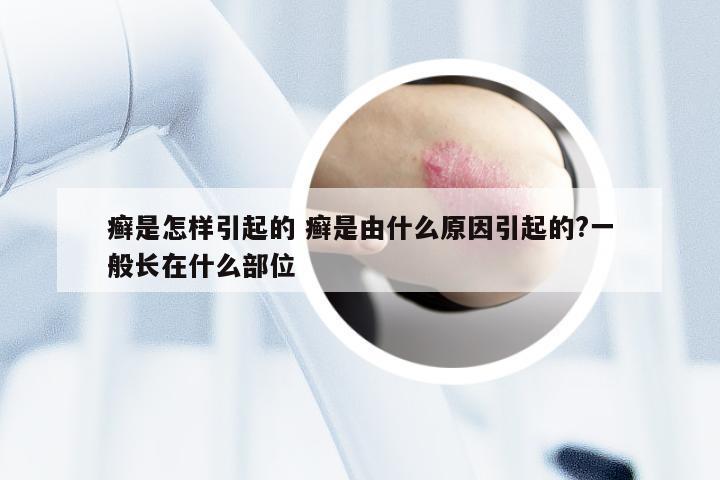 癣是怎样引起的 癣是由什么原因引起的?一般长在什么部位