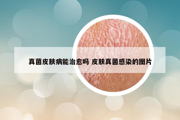 真菌皮肤病能治愈吗 皮肤真菌感染的图片