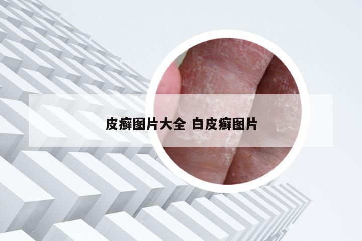 皮癣图片大全 白皮癣图片