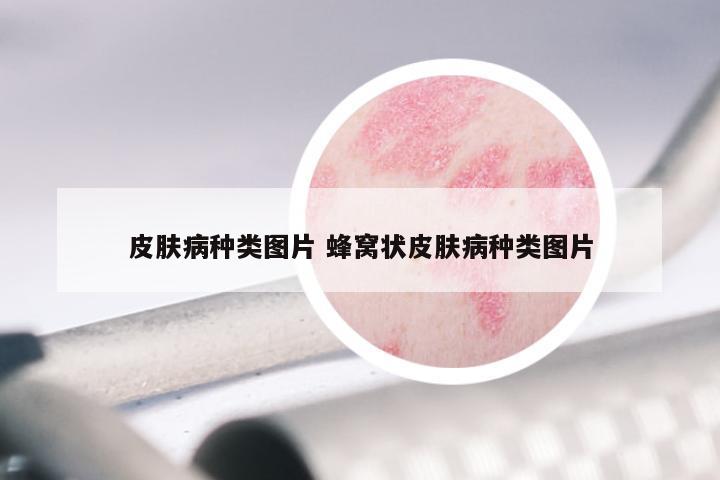 皮肤病种类图片 蜂窝状皮肤病种类图片