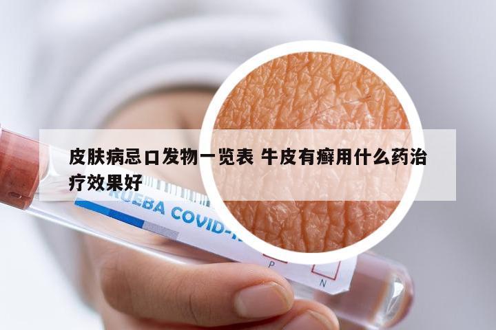 皮肤病忌口发物一览表 牛皮有癣用什么药治疗效果好
