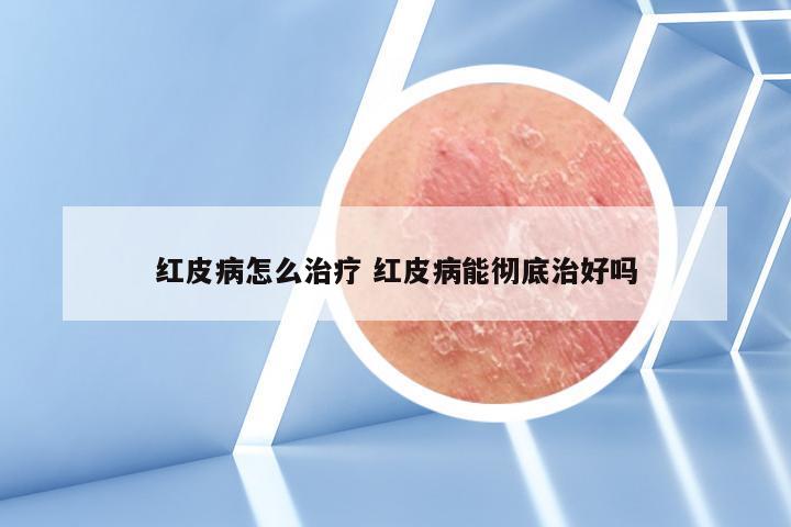 红皮病怎么治疗 红皮病能彻底治好吗