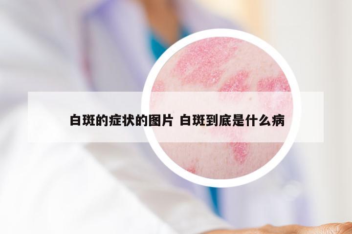 白斑的症状的图片 白斑到底是什么病