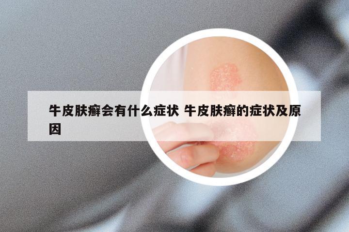 牛皮肤癣会有什么症状 牛皮肤癣的症状及原因